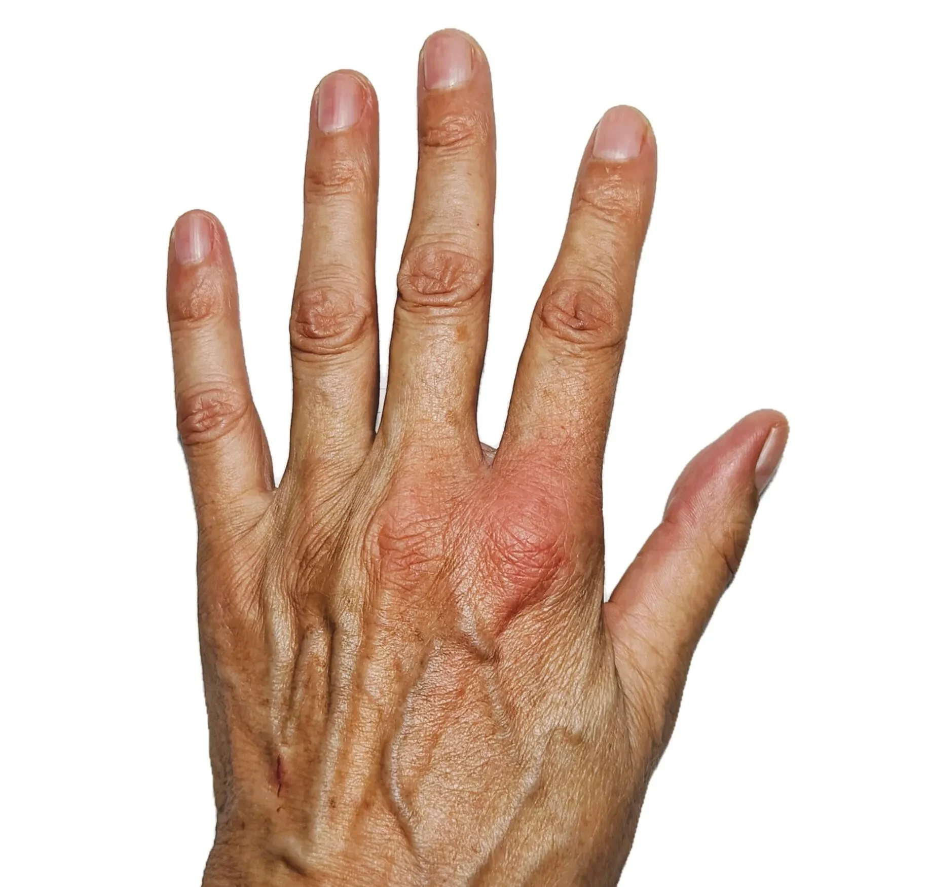 Palm – 15 Minutes After a Bee Sting